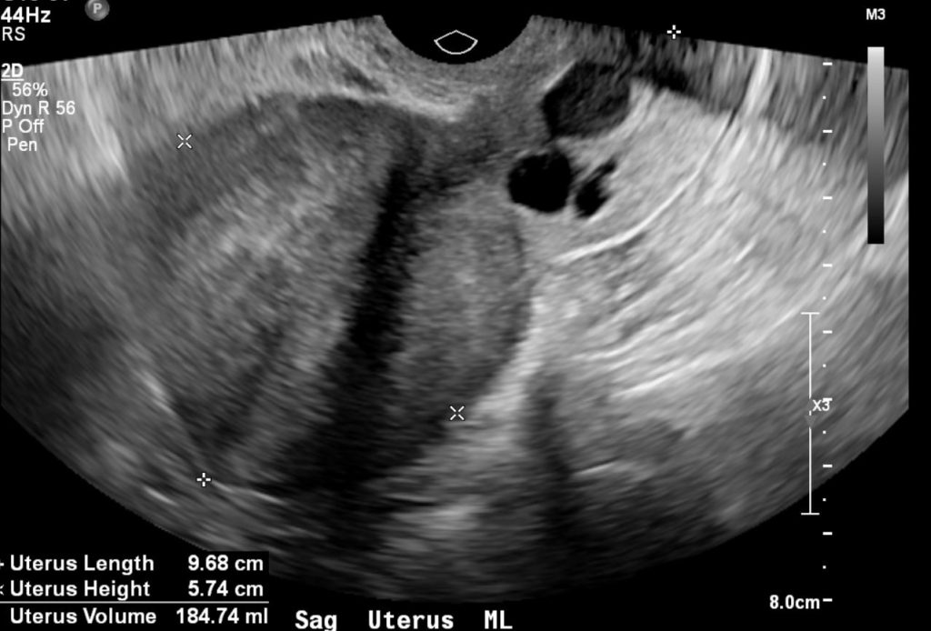Cervix Nabothian Cysts | Uterus