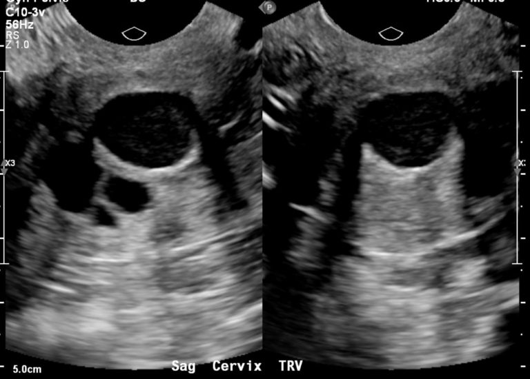 cervix-nabothian-cysts-uterus